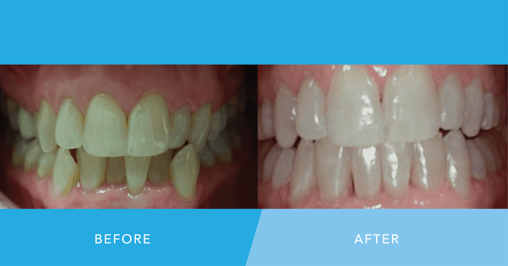 Six Month Smiles Braces and Bleaching Fulp Family Dentistry
